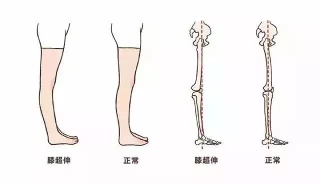 脚踝痛还继续运动会怎么样_运动后脚踝疼 多久能好_疼脚踝能运动好后会疼吗