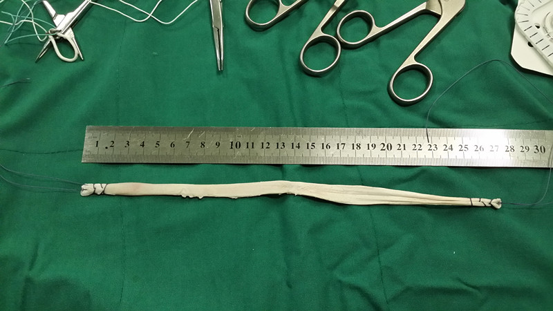 请为我找到交叉韧带康复视频_前交叉韧带康复训练图_交叉韧带运动康复