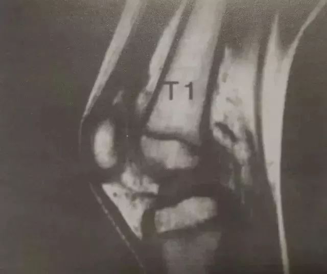 交叉韧带运动康复_前交叉韧带康复训练图_交叉韧带康复科一天多少钱