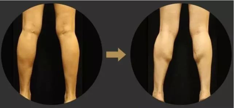 瘦小腿不同类型针对性训练_判断肌肉腿脂肪腿水肿腿_瘦腿操练视频