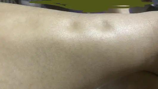 判断肌肉腿脂肪腿水肿腿_瘦小腿不同类型针对性训练_瘦腿操练视频