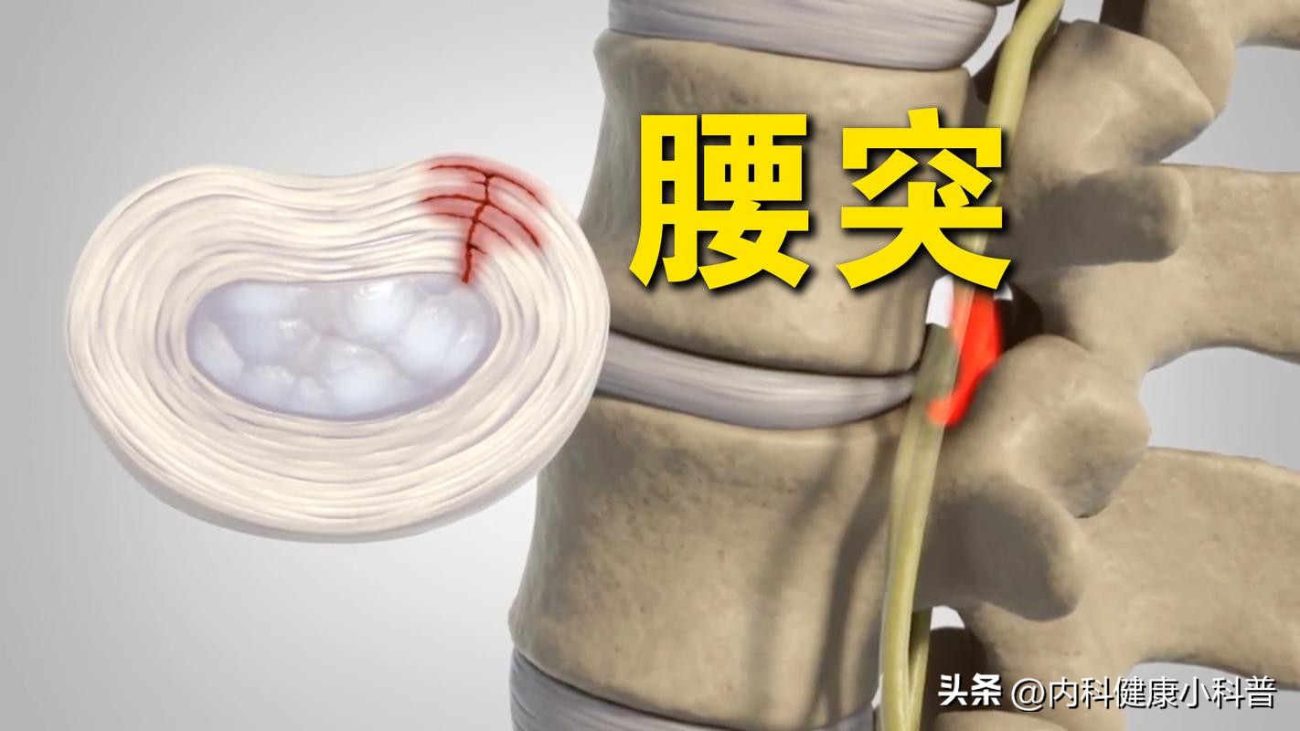 巅峰国际pg平台官网 再三提醒：腰椎间盘突出不想加重，3个动作要避免，保护腰部