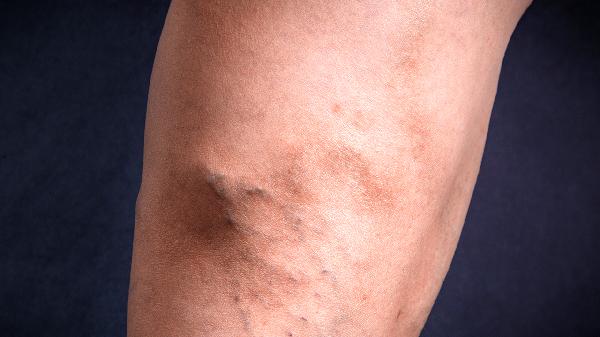 小腿肌肉紧绷走路难受怎么回事